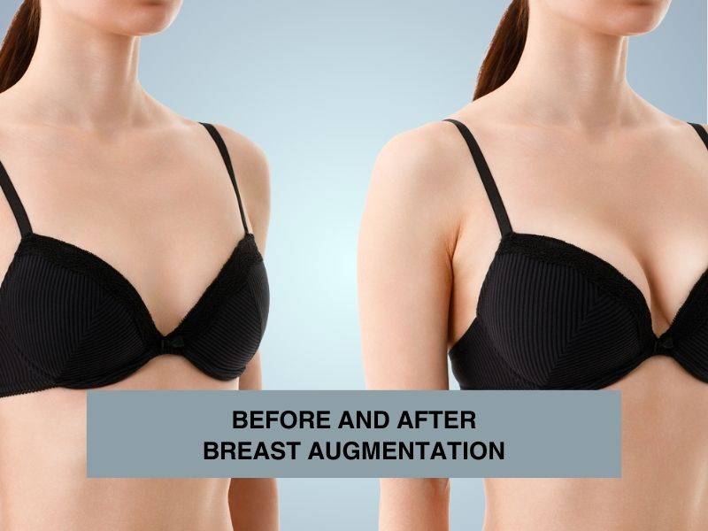 BEFORE AND AFTER BREAST AUGMENTATION