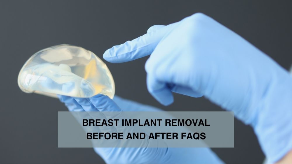 Breast Implant Removal Before and After FAQs