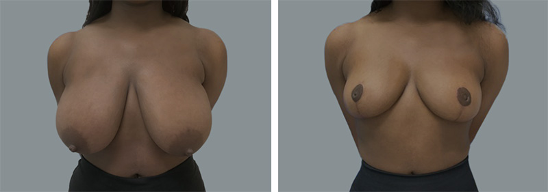 Las Vegas Breast lift before and after