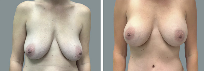 Las Vegas breast augmentation before and after