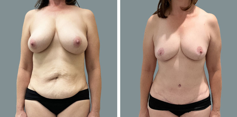 Las Vegas tummy tuck before and after