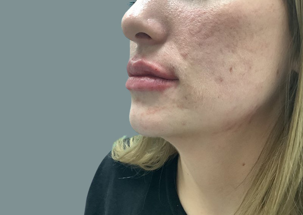 Lip fillers After Left