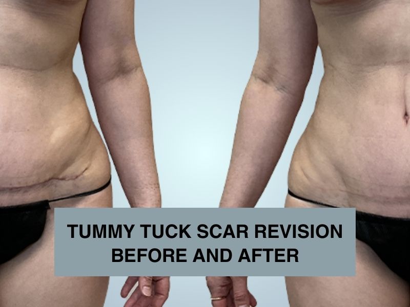 TUMMY TUCK SCAR REVISION BEFORE AND AFTER