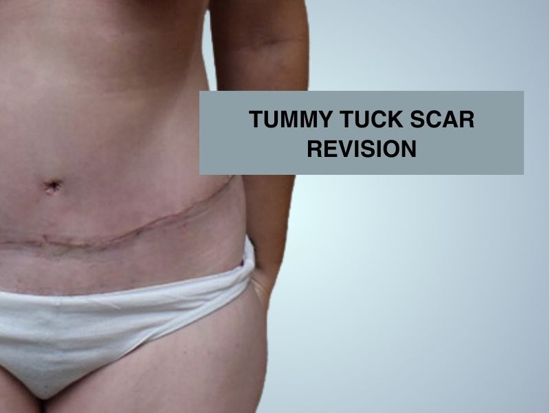 TUMMY TUCK SCAR REVISION