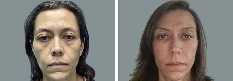 Tear Trough Fillers Before and After Las Vegas