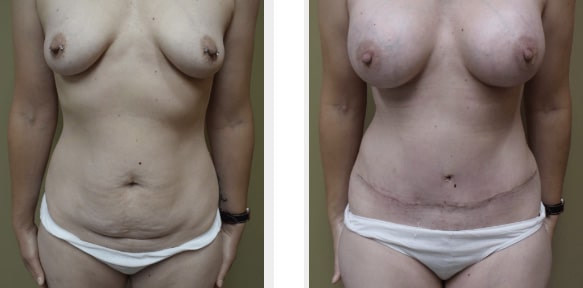 Weight loss after tummy tuck