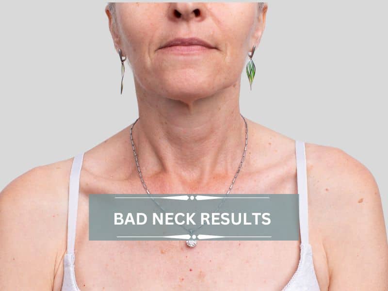 bad neck lift results