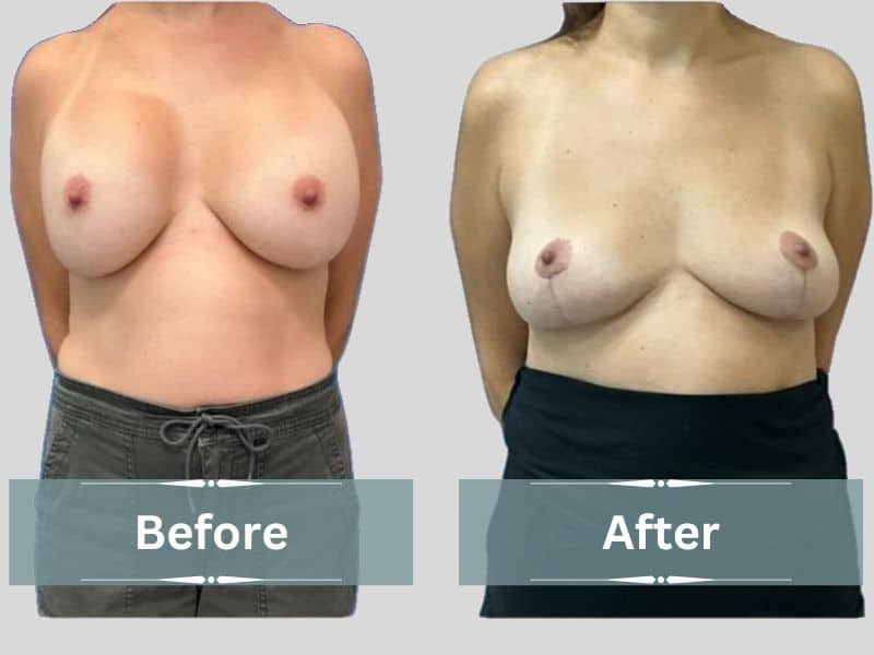 before and after breast implant removal