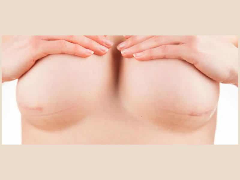  breast augmentation scar healing