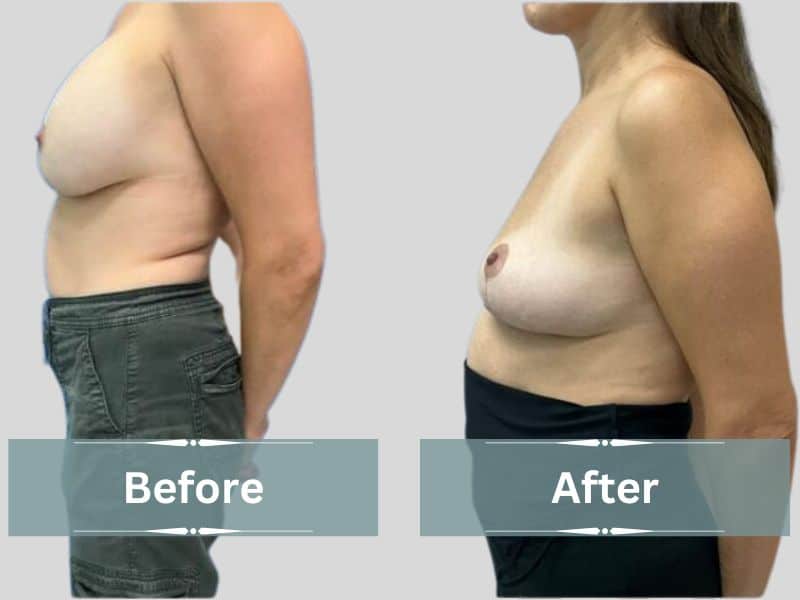 breast implant removal before and after photos