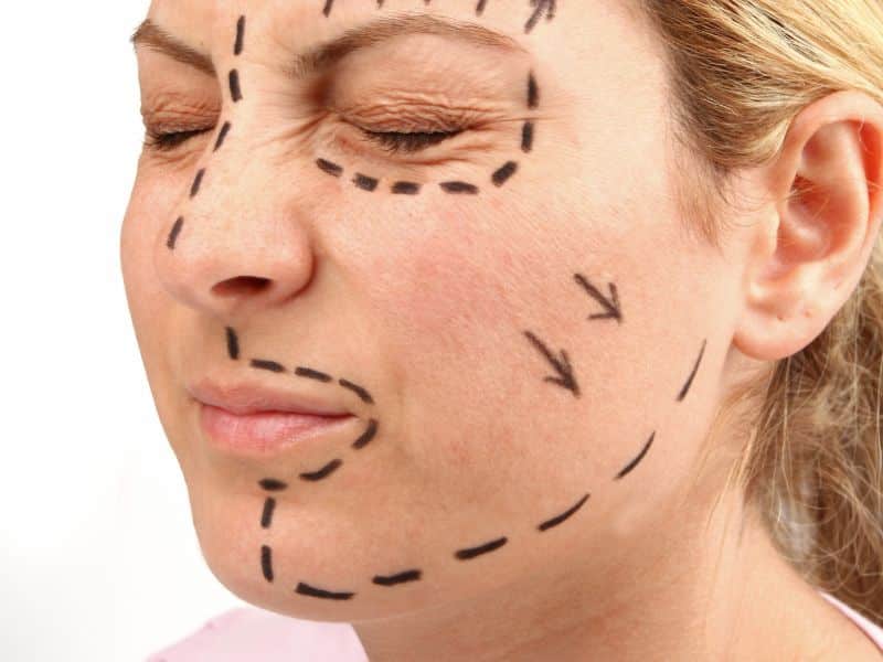 deep plane facelift surgery