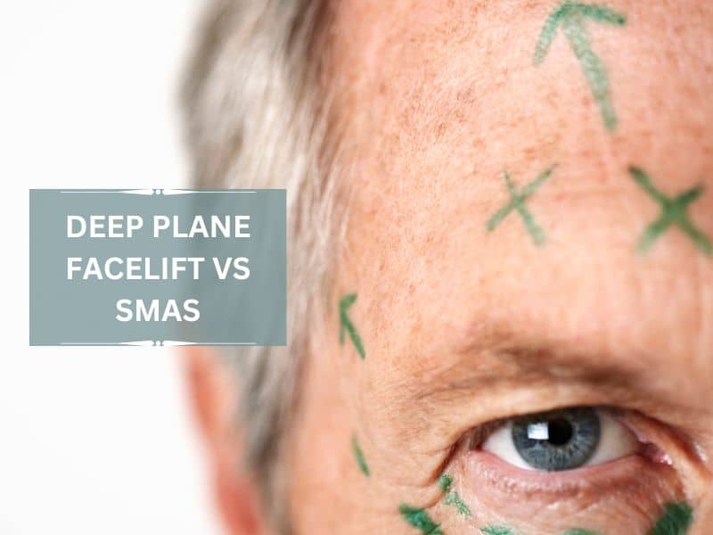 deep plane facelift vs smas