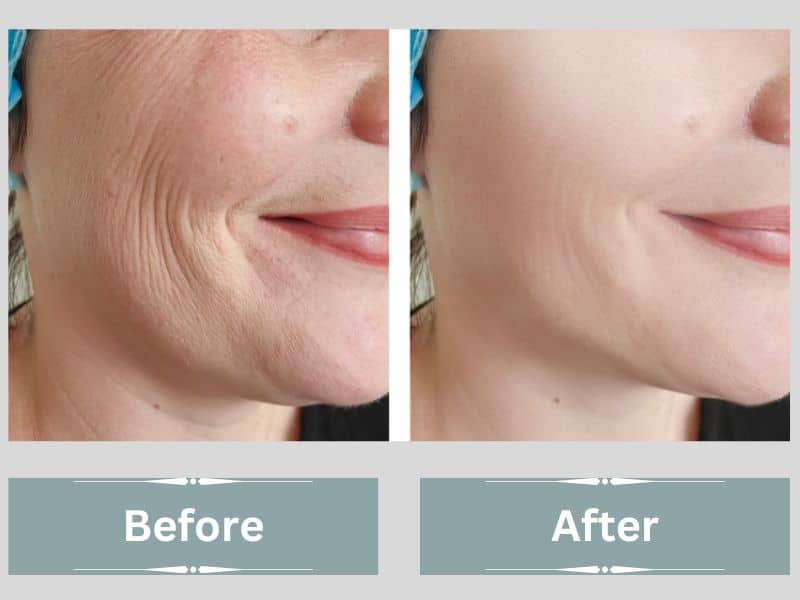 lower facelift before and after