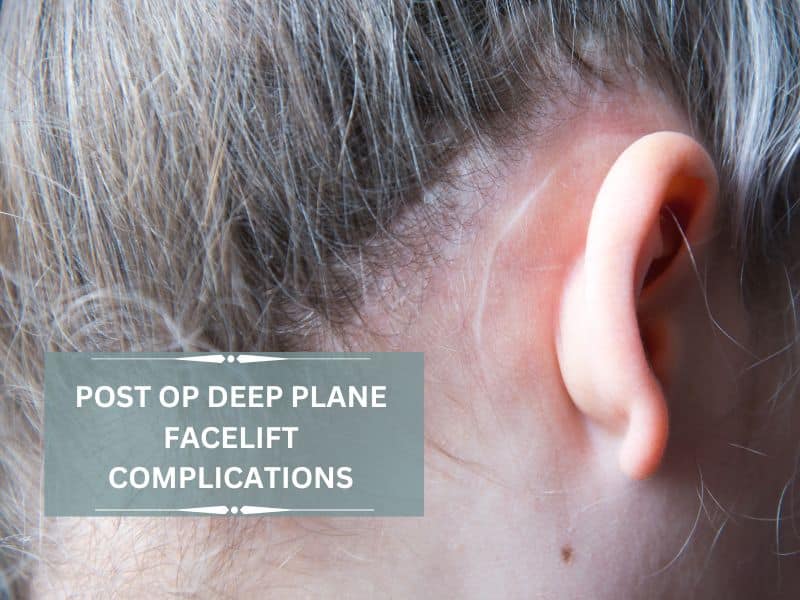 post op deep plane facelift complications