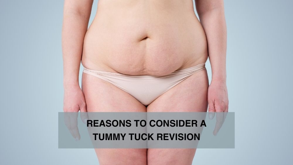 /Reasons to Consider a Tummy Tuck Revision