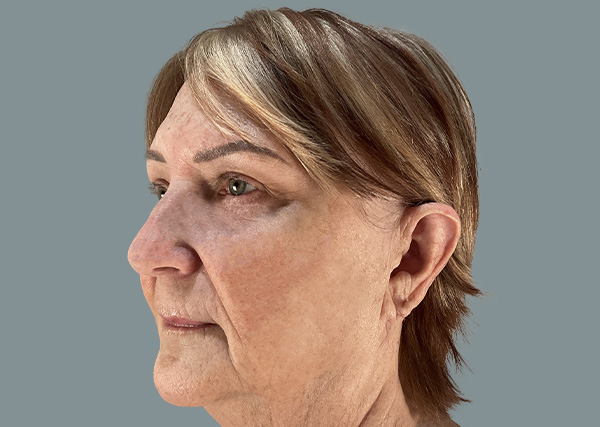 temporal brow lift scars