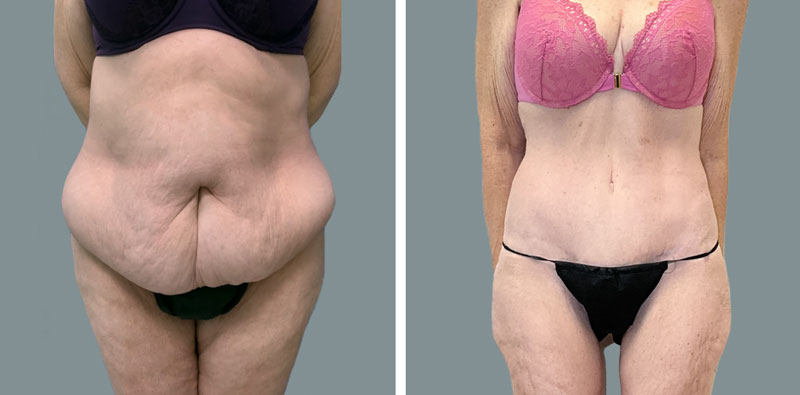 tummy tuck Las Vegas before and after